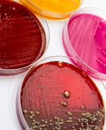 Costo delle infezioni batteriche insostenibile, urgenti strategie contro l’antibioticoresistenza